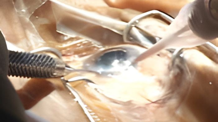 cataracts.22.6.jpg